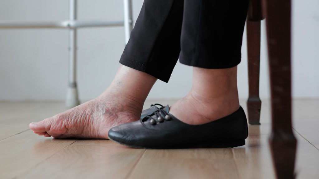 Wasser in den Füßen und Beinen? 8 Tipps, die Ihnen wirklich helfen MM Socks Wundersocks